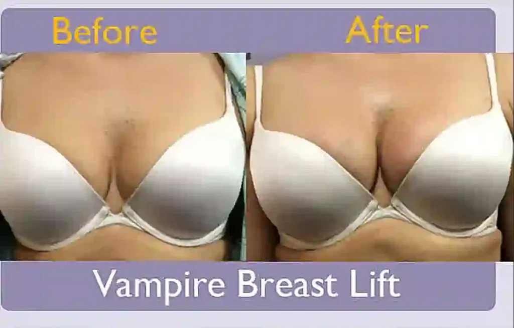 What Is a Vampire Breast Lift